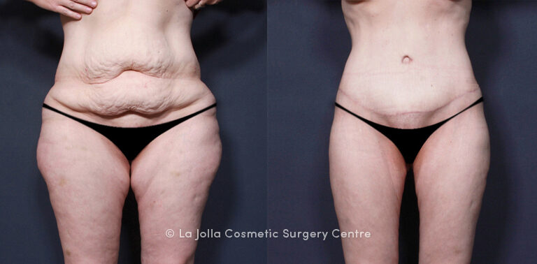 Will Insurance Cover Skin Removal After Weight Loss: Find Out Now 1 Will Insurance Cover Skin Removal After Weight Loss